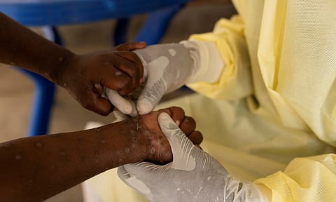 Africa Centers for Disease Control and Prevention (Africa CDC) warns of rising mpox cases