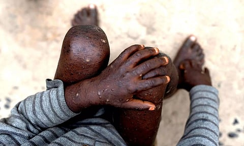 Monkeypox
