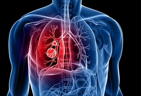 lung cancers