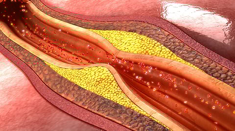 heart diseases