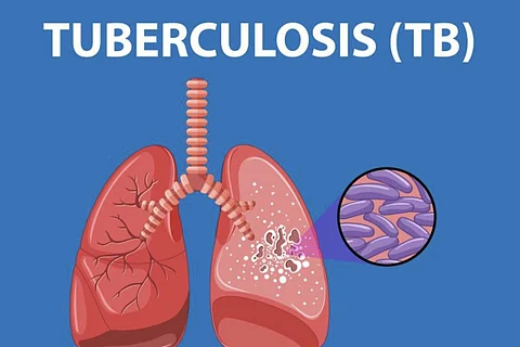 Tuberculosis