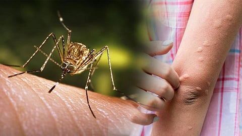 Japanese Encephalitis