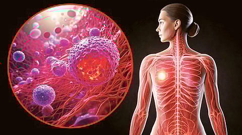 breast cancer