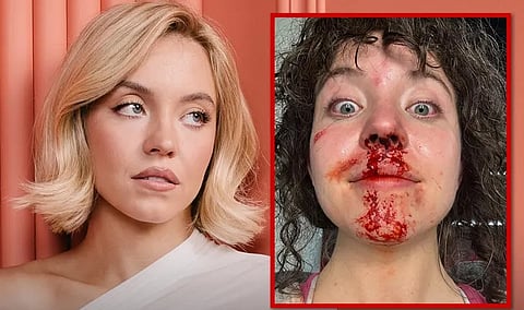 Hollywood star Sydney Sweeney on Injury While Filming ‘Christy’