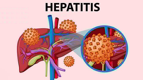 hepatitis