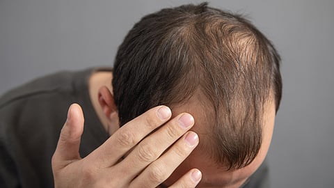 Hair Loss in Men