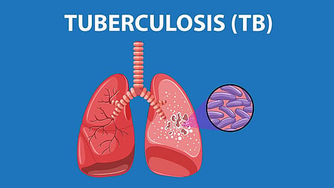 Tuberculosis