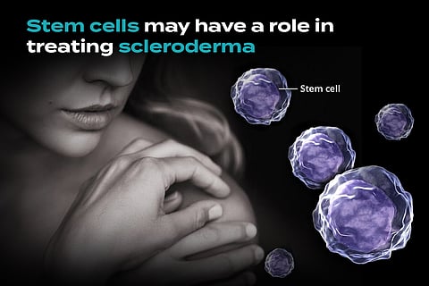 In the “Thick” of the Fight Against Scleroderma with Stem Cells