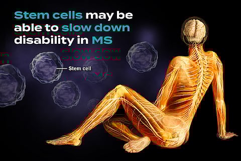 Could Stem Cells Slow Down Disability Progression in MS Patients?