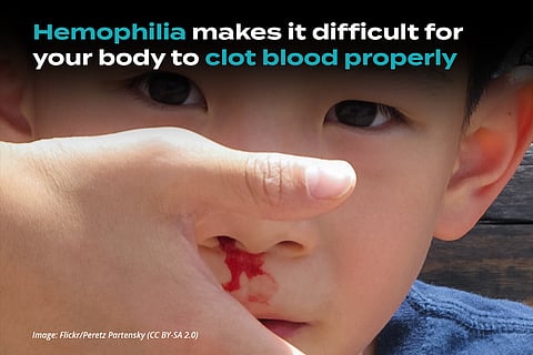 Hemophilia: When Your Blood Won’t Clot and You Can’t Stop Leaking