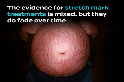 Are Stretch Mark Treatments a Waste of Money?