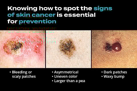 Skin Cancer Is in Style This Summer. Protect Yourself to Buck the Trend.