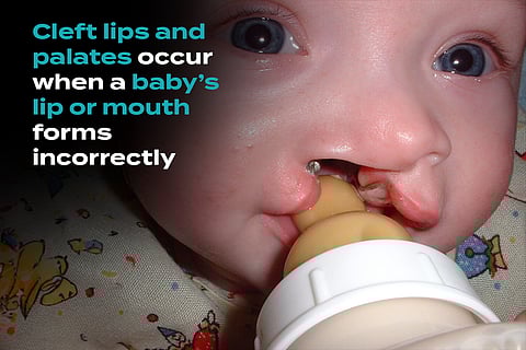 If Babies Were Jigsaws, Cleft Lips Would Be the Missing Final Piece