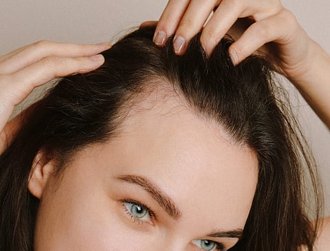 Alopecia on the rise among young adults; unhealthy diet, unregulated lifestyle to blame