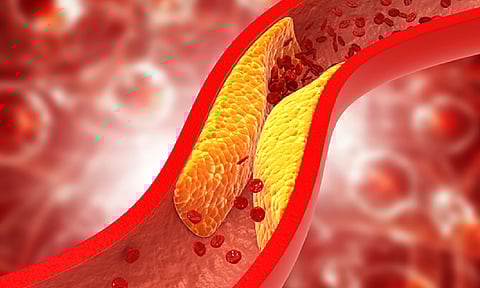 Studies show gene-based drugs to lower cholesterol in people with naturally high levels