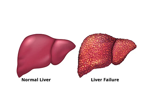 Fulminant Hepatic Failure: How fast can it affect healthy individuals?