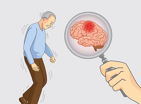 Patterns of brain shrinkage in Alzheimer's disease found to be unique