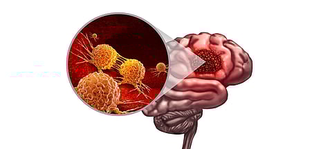 Glioblastoma: why immunotherapy may offer hope for brain cancer patients