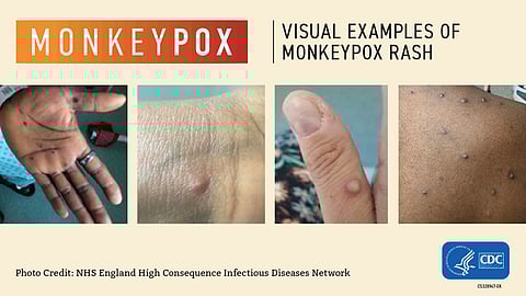 Monkeypox Is Spreading in King County: 5 Things to Know