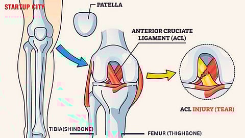 Anterior Cruciate Ligament