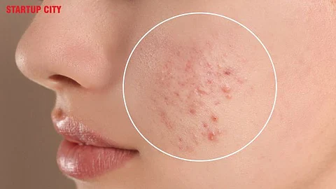 Acne
