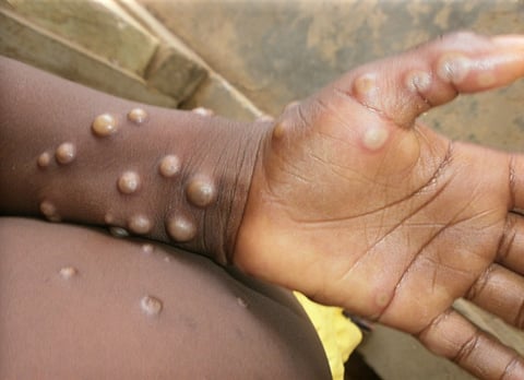 Davao CHO monitors contacts of Mpox cases