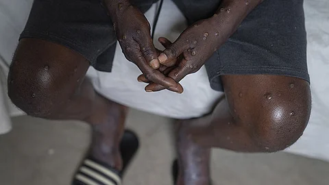 CONGO. An unidentified man infected with mpox at the Goma General Hospital, Democratic Republic of the Congo, on July 16, 2024 where he continues treatment.