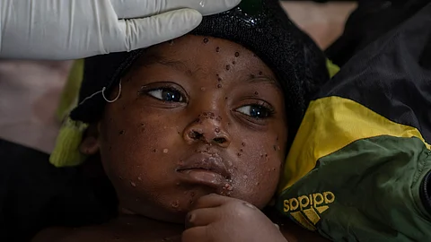 Emile Miango, 2, who has mpox, lies in the hospital, on Wednesday, September 4, 2024, in Kamituga, South Kivu province, which is the epicenter of the world’s latest outbreak of the disease in eastern Congo. (AP Photo)