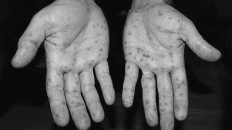 Hand, Foot, and Mouth Disease (HFMD)