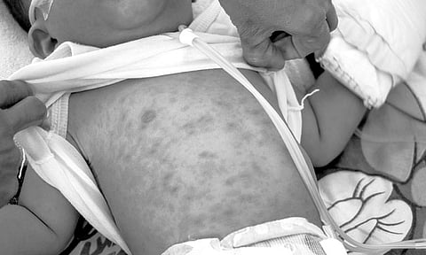 1,000 ka mga kaso sa tipdas natala sa nasod