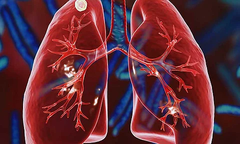 Davao City logs 2-K TB Q1 cases, CHO ramps up detection efforts