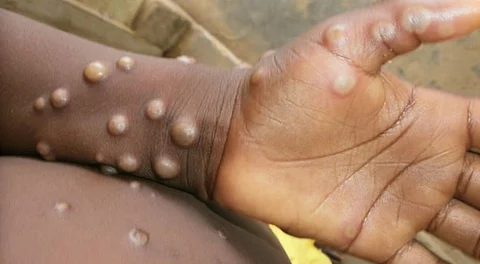 Suspected Mpox case reported in Mandaue City