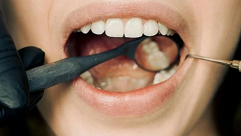 LGUs urged to prioritize oral healthcare