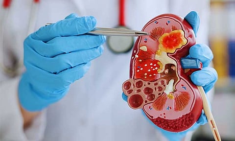 SPMC to open Kidney and Transplant Institute, aims for 100 dialysis beds