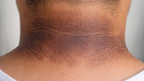 Dark patches on skin