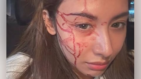 Thea Astley slips in bathroom, hits head before concert