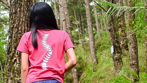 Experts underscore importance
of early screening vs scoliosis