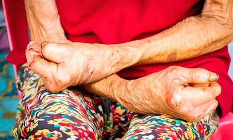 CHO: Leprosy is curable, free meds available