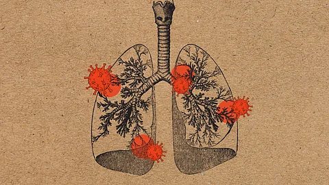 Covid-19 virus impacting lungs