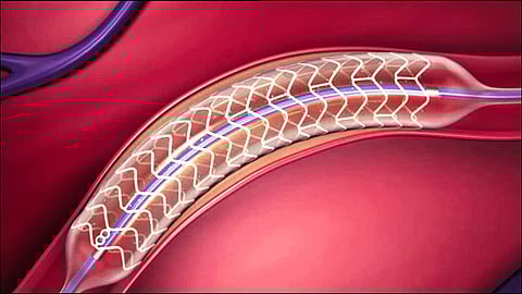 stent Representational Image