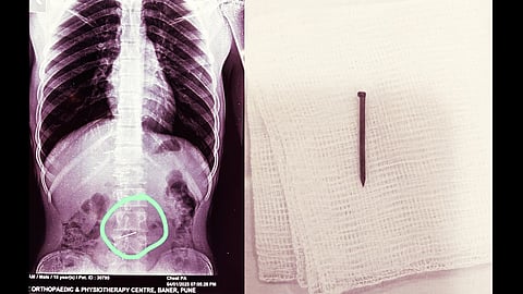 Nail swallowed extracted and its x-ray
