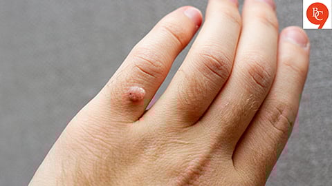 Effective home remedies for warts, Remedies for natural glowing skin, Simple home remedies for warts