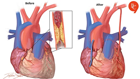 Coronary Artery Disease, CAD myths, Heart surgery facts