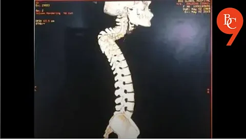 Doctors Save 12-Year-Old from Paralysis with Endoscopic Spine Surgery