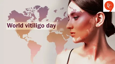 World Vitiligo Day: Embracing Skin Diversity and Redefining Beauty Standards