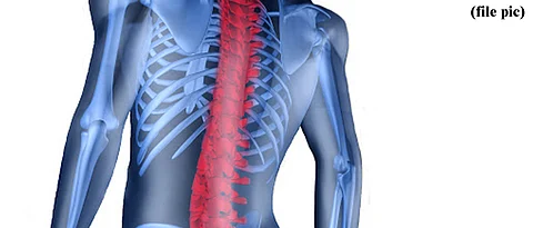 Girl treated for Kyphosis at SGH