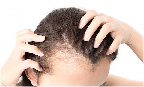 Different Ways To Deal With Hair Loss