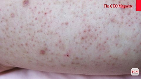 Actinic Keratosis