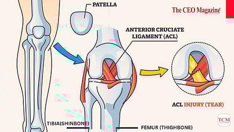 Anterior Cruciate Ligament