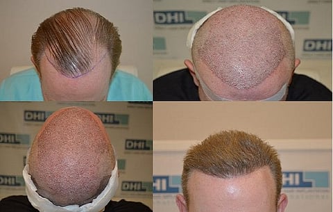 12,000 plus follicles implanted for a complete transformation, in just 11 hours!